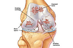 Easy Exercises for Knee Arthritis