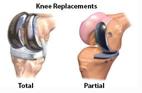 Total and partial knee replacement surgery