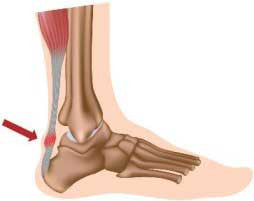 Achilles Tendinitis