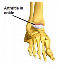 Ankle Arthritis
