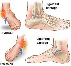 Ankle Sprain