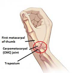 CMC Joint