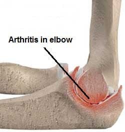 Elbow Arthritis