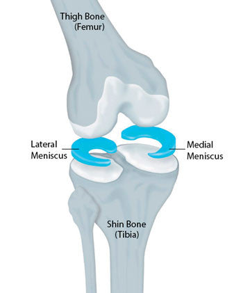 Knee Pain and Meniscus Damage