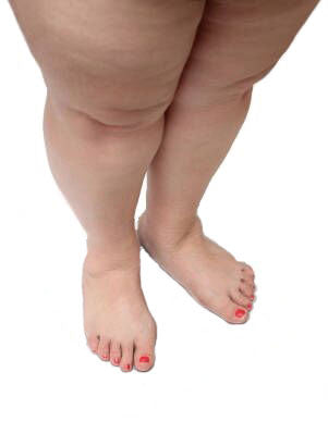 Obesity and Knee Arthritis