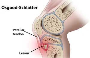 Osgood Schlatter