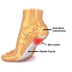 Plantar Fasciitis