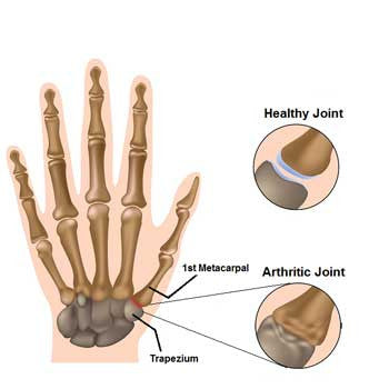 Thumb Arthritis