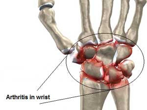 Wrist Arthritis
