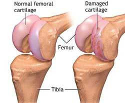 Common Knee Pain