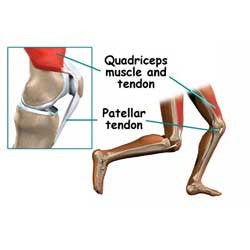Jumpers Knee Patella Tendinitis