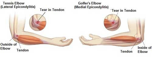 Elbow Pain